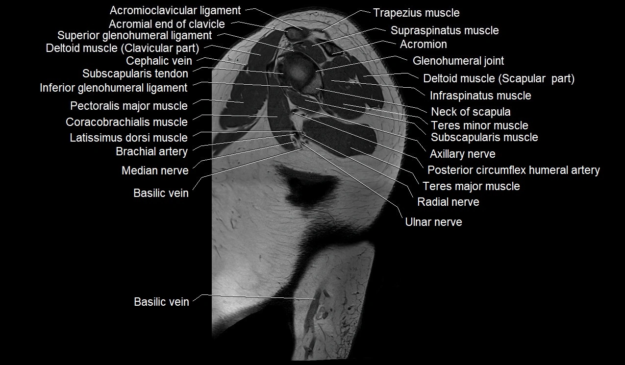 Upper arm (humerus ) saittal cross sectional anatomy 3T image 27.webp